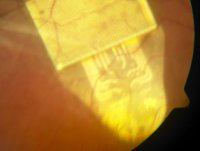 Retina Implant unter der Netzhaut eines Patienten, mit DS-Elektroden. Aufnahme: Univ.-Augenklinik Tübingen