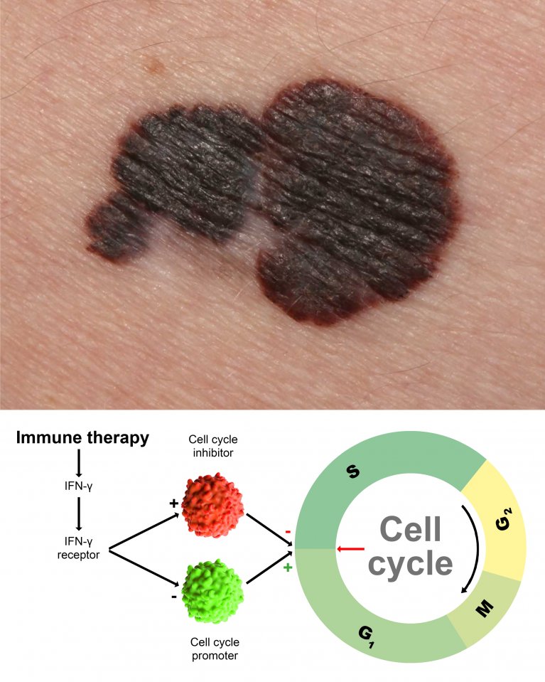 im oberen Bild: ein Melanom; im unteren Bild: Schemata des Zellzyklus mit seinen vier Phasen. Zur Immuntherapie muss zwischen der G1- und der S-Phase entweder das Interferon die Wachstumsbremse aktivieren oder den Wachstumsbeschleuniger hemmen.
