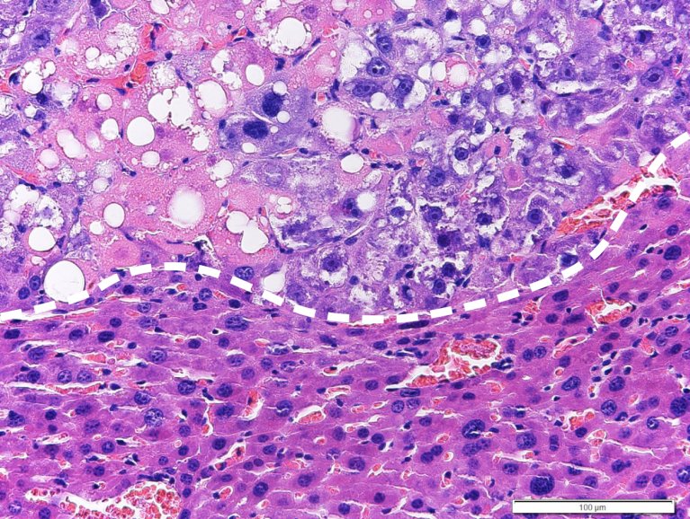 PM_Uniklinikum_Uni Tübingen_Lebertumor in Behandlung_Mikroskop