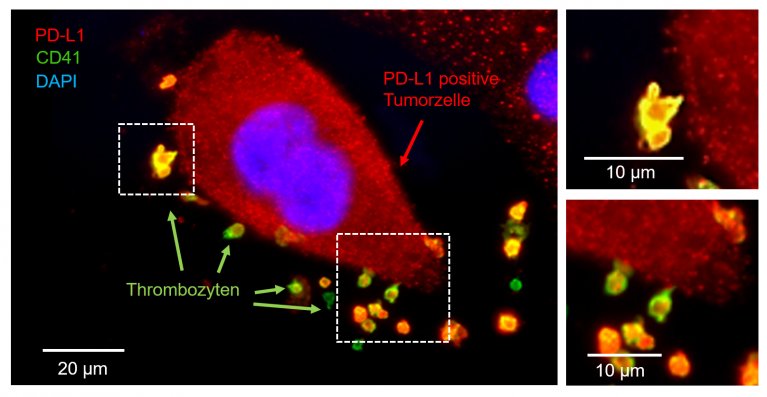 Thrombozyten interagieren mit einer Lungentumorzelle und nehmen dabei das Molekül PD-L1 auf.